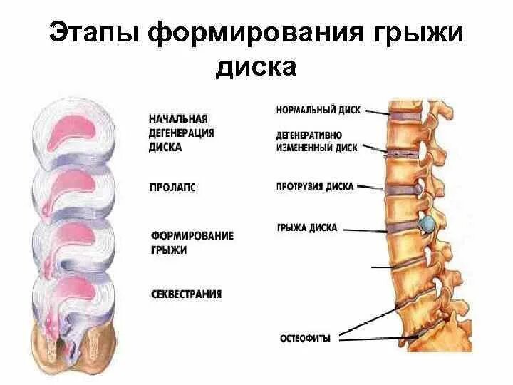 1 стадия грыжи. 1 стадия грыжи