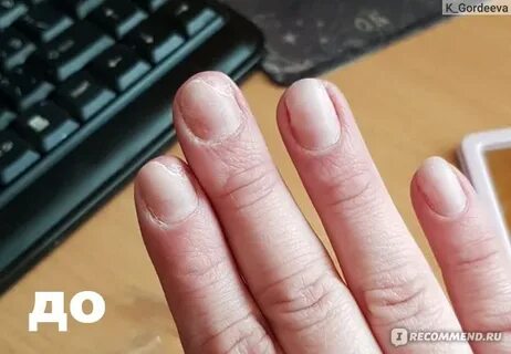Лосьон стоп онихолизис