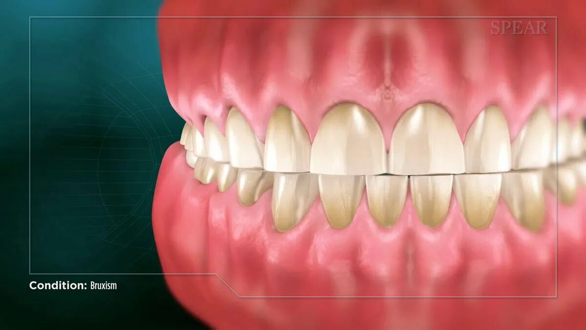 Бруксизм скрежетание зубами. Бруксизм стирание зубов. Патологическая стираемость зубов.