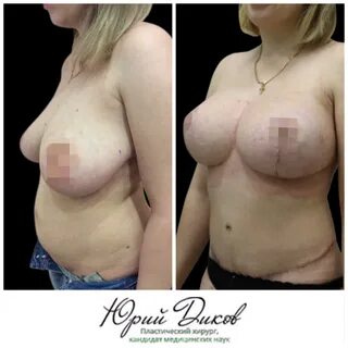 Вертикальная подтяжка с установкой круглых имплантов 280 сс Абдоминопластик...