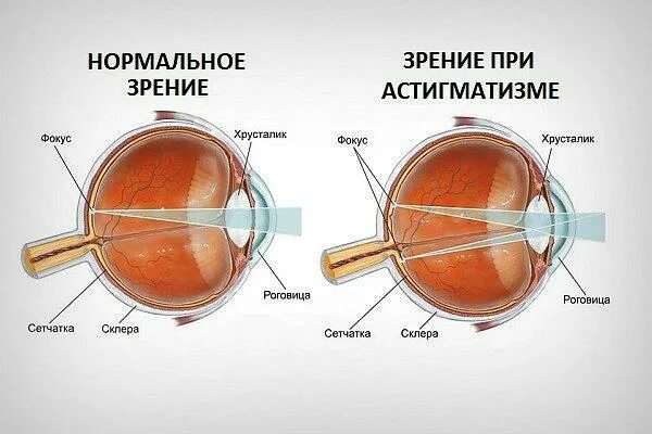 Гиперметропия высокой степени с астигматизмом. Сложный гиперметропический астигматизм. Гиперметропический астигматизм у детей. Астигматизм фокус. Сложный гиперметропический астигматизм глаз