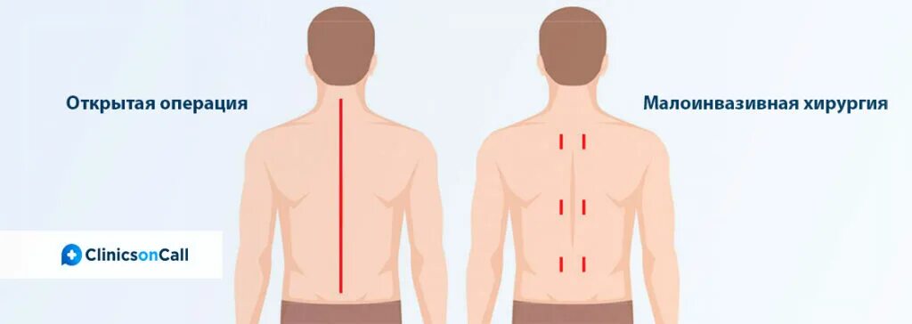 Малоинвазивная хирургия позвоночника. Малоинвазивные операции на позвоночнике. Шрам после операции на позвоночнике. Виды операций на спину. Операция на позвоночнике отзывы пациентов