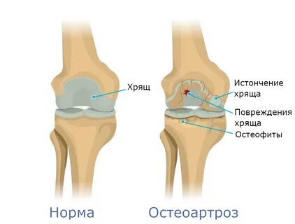 Артроз коленных суставов причины лечение