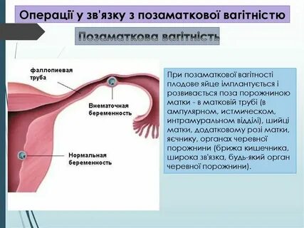 Как понять маточная или внематочная
