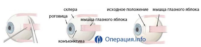 Операция по исправлению косоглазия у детей. Операция по косоглазию. операция на косоглазие у детей. наркоз операция на косоглазие.