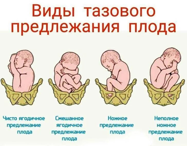 Положение продольное головное. Продольное предлежание плода головное вниз. тазовое предлежание плода классификация. продольное положение плода тазовое предлежание плода. признаки тазового предлежания плода.