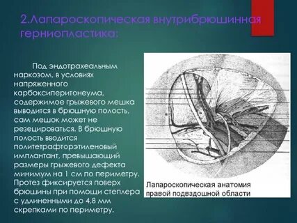 Пупочная герниопластика