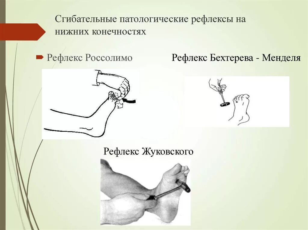 Рефлексы верхних конечностей. Рефлекс Бабинского Оппенгейма Гордона. Рефлекс Бехтерева-Менделя. Рефлексы Жуковского и Бабинского. Патологические рефлексы в неврологии сгибательные.