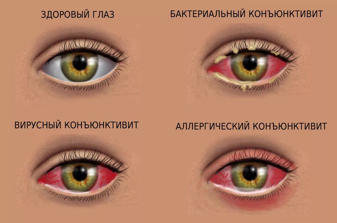 Гонятся глаза. Бактериальный конъюнктивит глаз. Герпетический вирусный конъюнктивит. Конъюнктивит у взрослых симптомы. Вирусный конъюнктивит симптомы.