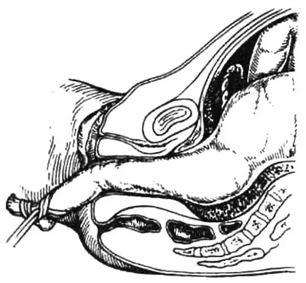 Ручное отделение плаценты. Процесс рождения последа. Влагалищные своды