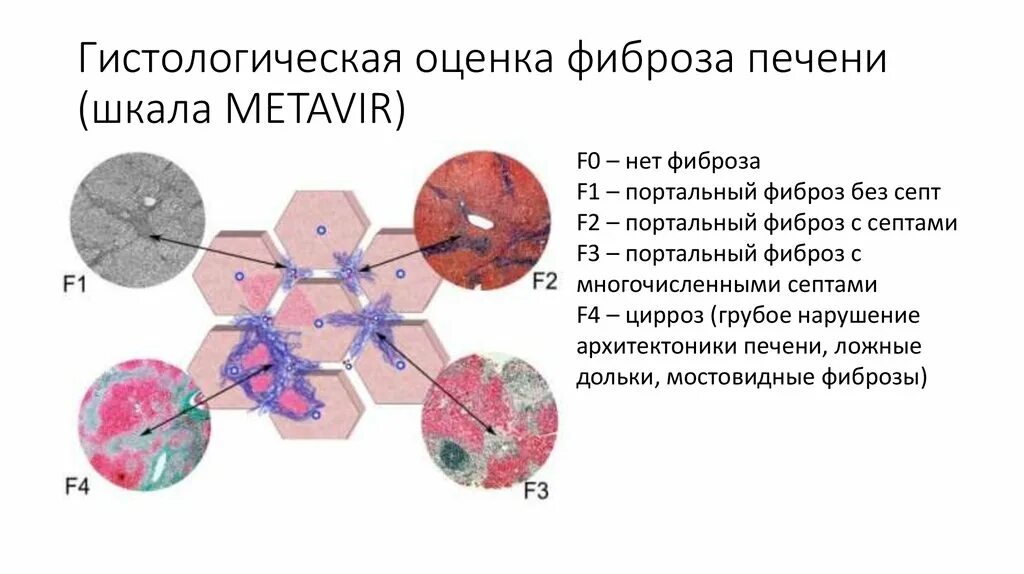 Стадии развития фиброза печени. Шкала метавир фиброза печени. Фиброз печени f2 по шкале metavir. Степени фиброза печени по шкале метавир.