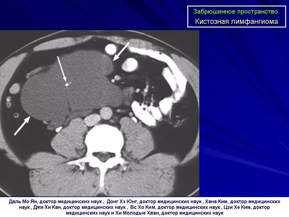 Мюллерова киста забрюшинного пространства кт. Опухоли забрюшинного пространства кт. Внеорганные опухоли брюшной полости мрт. Патологическое пространство