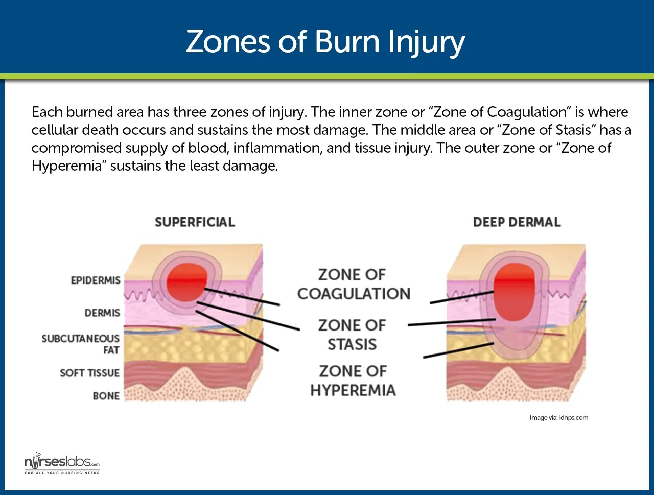 Three zones