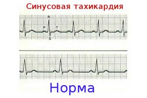 Нерегулярный синусовый