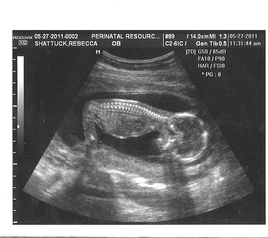 Снимок УЗИ на 16 неделе беременности. УЗИ 16 недель пол ребенка. На 15 неделе можно узнать пол