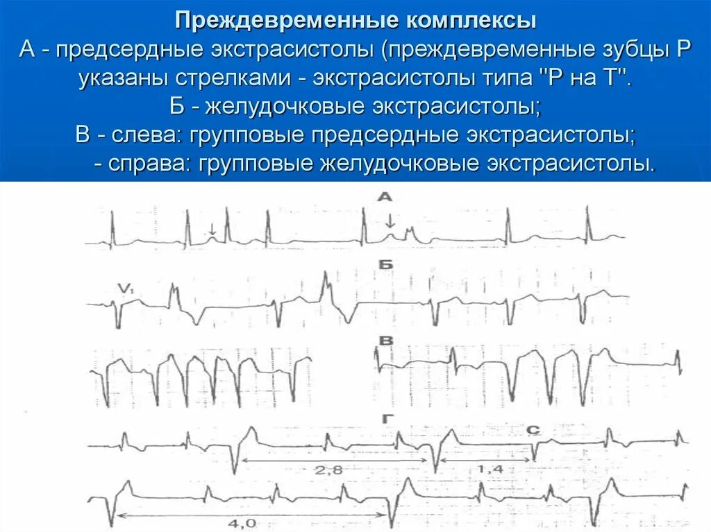 Предсердная экстрасистолия на ЭКГ. Синусово-предсердная экстрасистолия. ЭКГ критерии желудочковой и предсердной экстрасистолии. Блокированная предсердная экстрасистолия на ЭКГ. Блокированные экстрасистолы