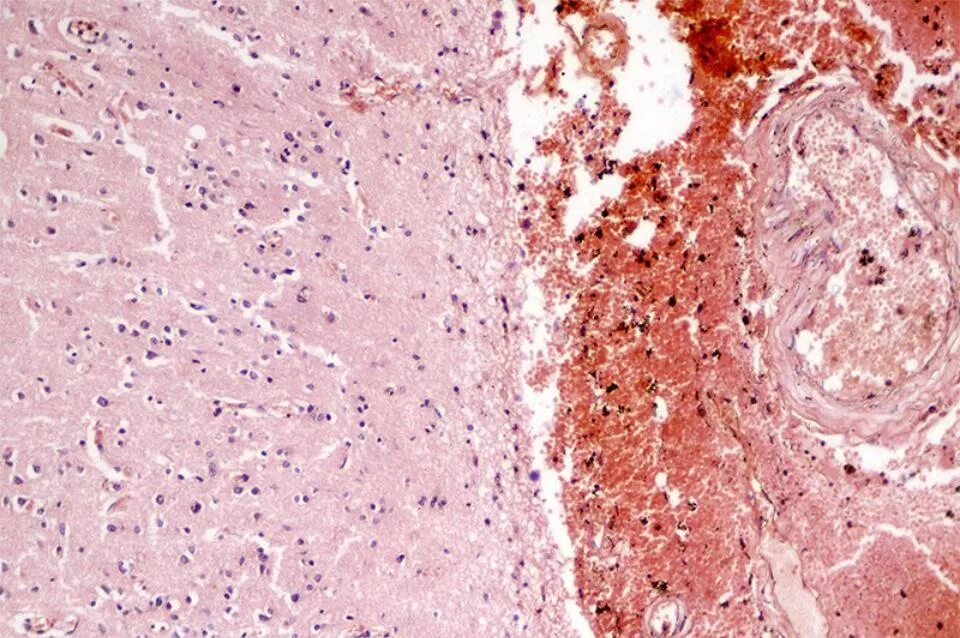 Микропрепарат головного мозга. Геморрагический инсульт гистология препарат. Субарахноидальное кровоизлияние гистология. Геморрагический инфаркт головного мозга патанатомия. Гематома головного мозга микропрепарат.