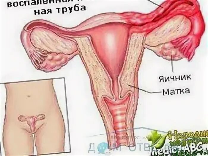 Можно забеременеть с одной трубой. Забеременеть с одной трубой. зачатие с одной трубой. возможно ли забеременеть с одной маточной трубой.