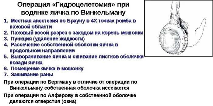 Болит в правом яичке у мужчин. Операции при гидроцеле (водянке оболочек яичка). Водянка яичка операция Винкельмана. Волянеа оболочки яичника. Операция Винкельмана показания.