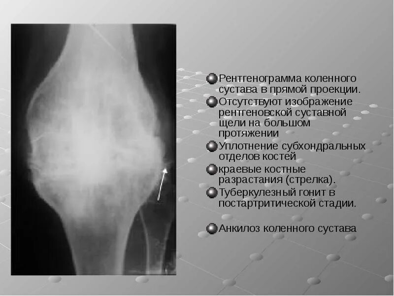 Анкилоз тазобедренного сустава. Анкилоз коленного сустава рентгенограмма. анкилоз коленного сустава рентген. костный анкилоз коленного сустава рентгенограмма. костный анкилоз коленного сустава на рентгене.