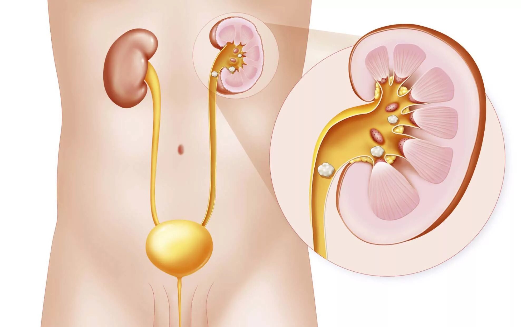 Мочеточник отходит от. Почечнокаменная болезнь. Камни в мочевыделительной системе. Мочекаменная болезнь камни.