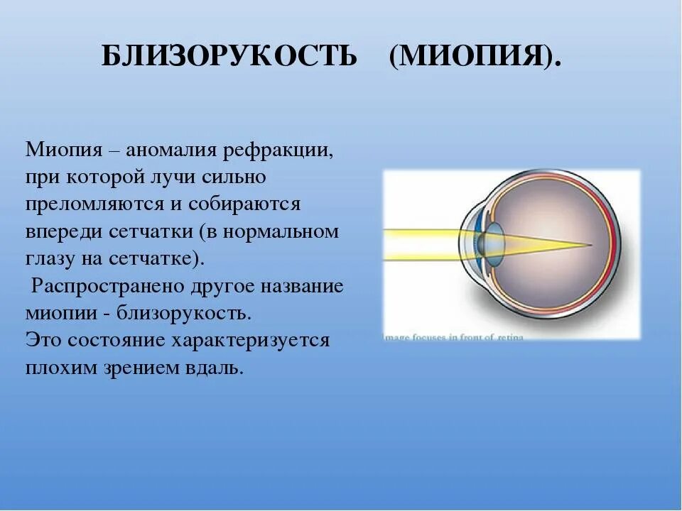 Миопия что это простыми словами. Рефракция миопия. Близорукость миопия. Близорукость сетчатка. Аномалии рефракции близорукость.