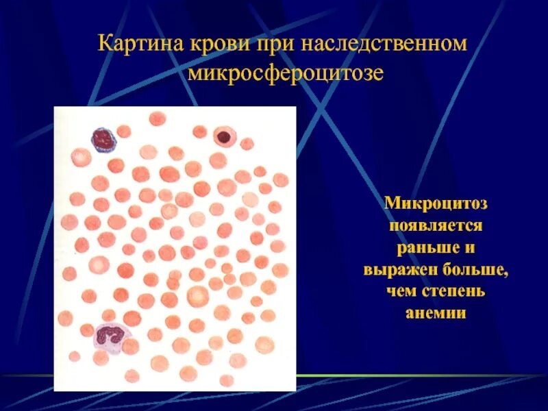 Микроцитоз в общем анализе что это. Гипохромия микроцитоз. микроцитоз анизоцитоз гипохромия.