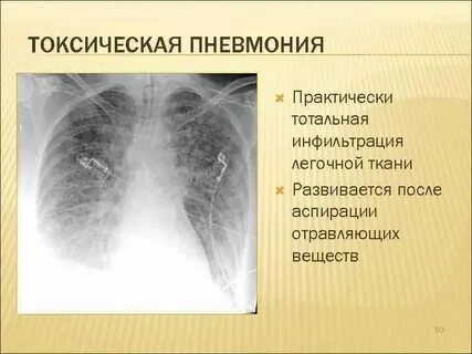Плазменная пневмония