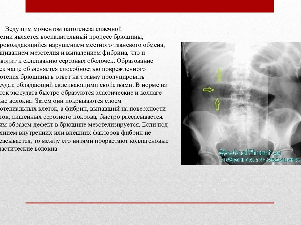 Спаечный процесс код мкб 10. Спаечный процесс код мкб 10