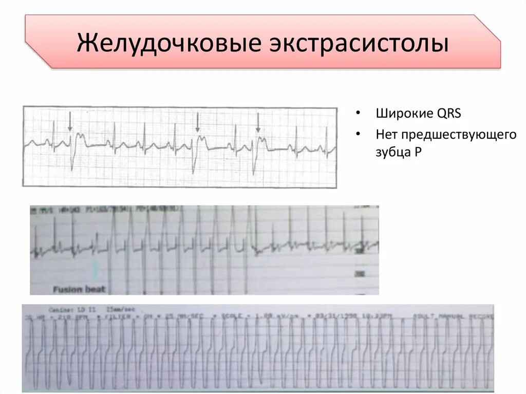 QRS желудочковой экстрасистолы формы. QRS У желудочковой экстрасистолы. Морфология желудочковых экстрасистол. Желудочковые экстрасистолы фото. Типы желудочковых экстрасистол