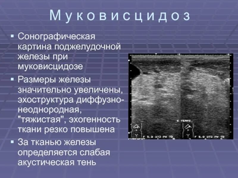 Структурные изменения поджелудочной железы. Неоднородная поджелудочная железа УЗИ. УЗИ диффузные изменения эхоструктуры поджелудочной железы. Неоднородная структура поджелудочной железы на УЗИ. Эхоструктура неоднородная.