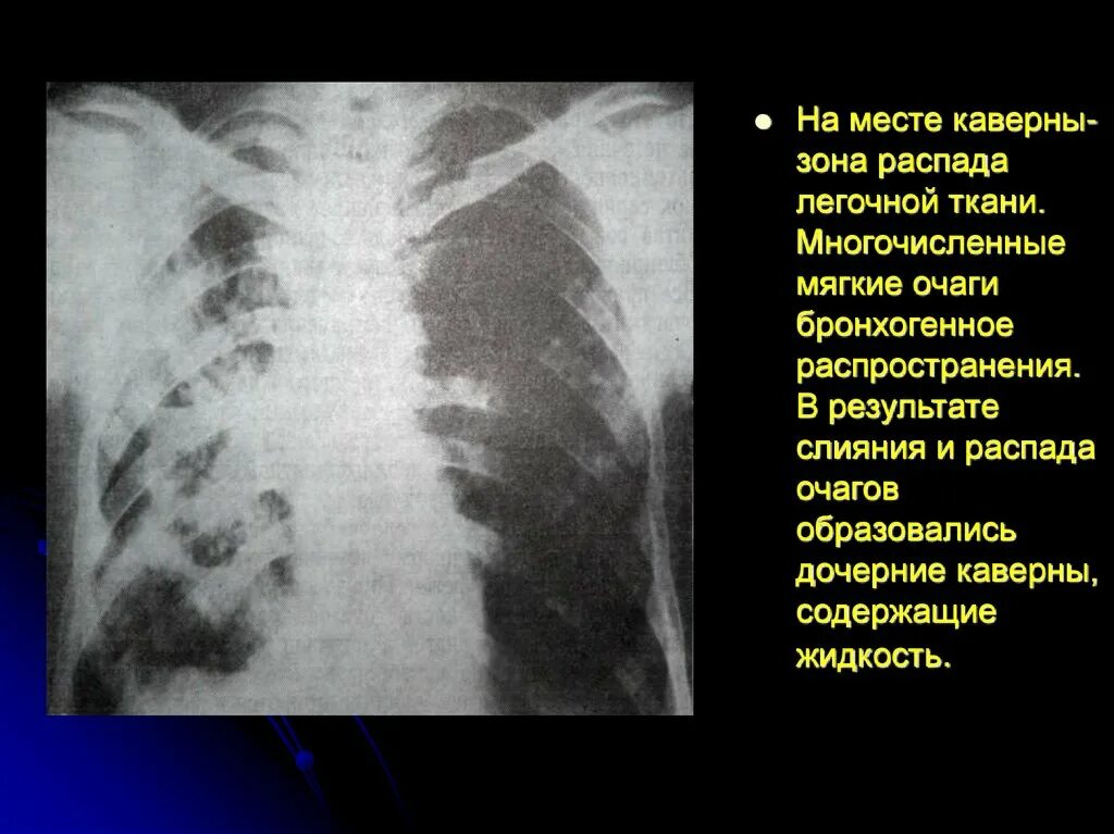 Очаговое поражение легких. Очаговые поражения лёгких. Распад и формирование каверны в легких.