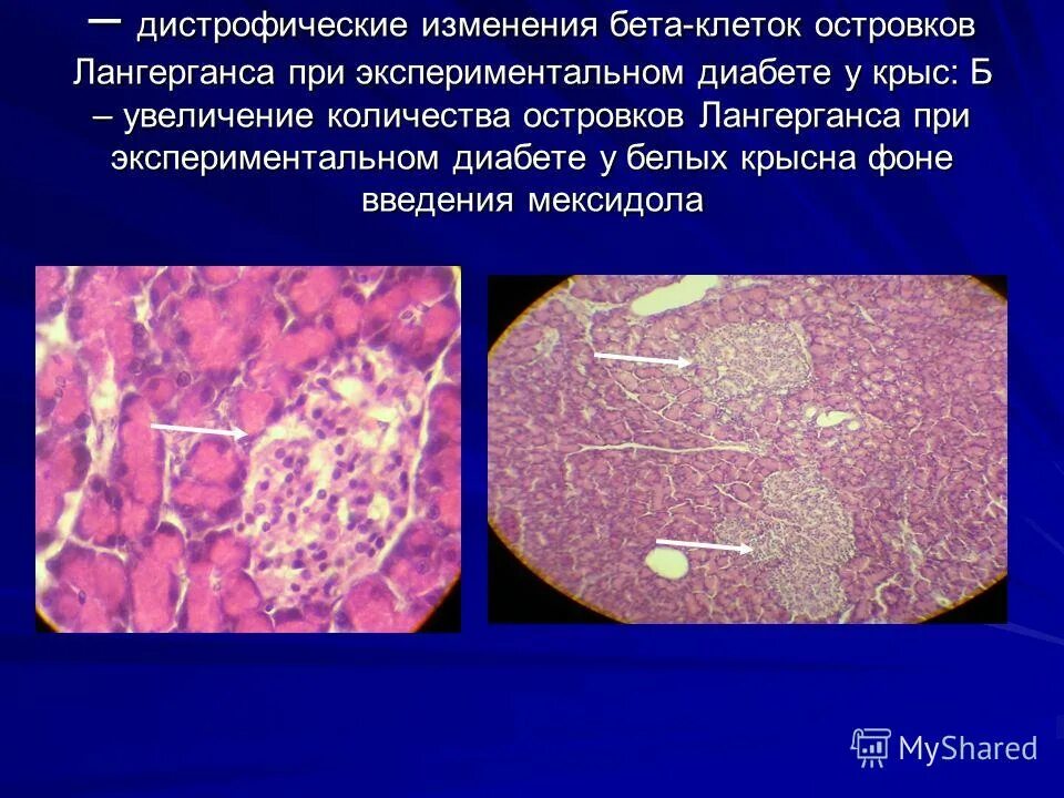 деструкция бета клеток