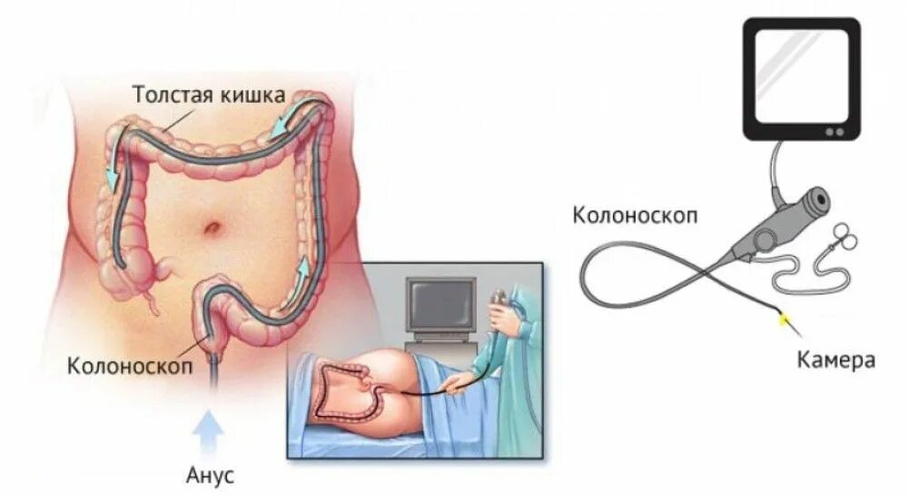 Колоноскопия прямой кишечника. Колоноскопия схема проведения. путь проведения эндоскопа при колоноскопии. колоноскопия методика исследования. биопсия колоноскопия толстой кишки.