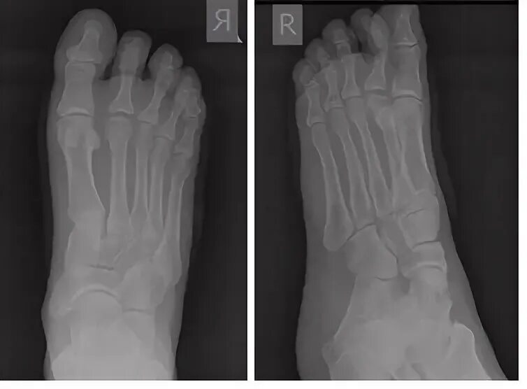 Остеохондропатия 5 плюсневой кости рентген. Остеохондропатия 2 плюсневой кости. Остеохондропатия 1 плюсневой кости.