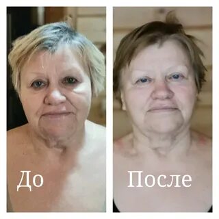 Витапластика лица что это такое отзывы
