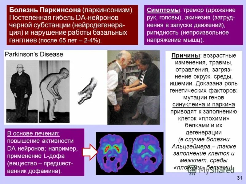 Болезнь Паркинсона. Болезнь Паркинсона симптомы. Паркинсонизм и болезнь Паркинсона. Болезнь Паркинсона симп. Болезнь паркинсона борьба