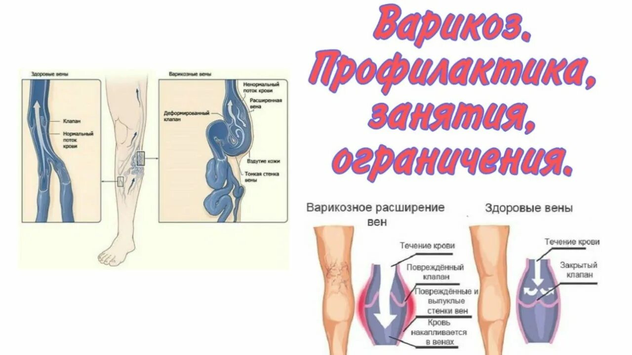 Варикозное расширение вен брошюра. Профилактика варикозного расширения вен. Упражнения для профилактики варикоза. Расширение вен нижних конечностей профилактика