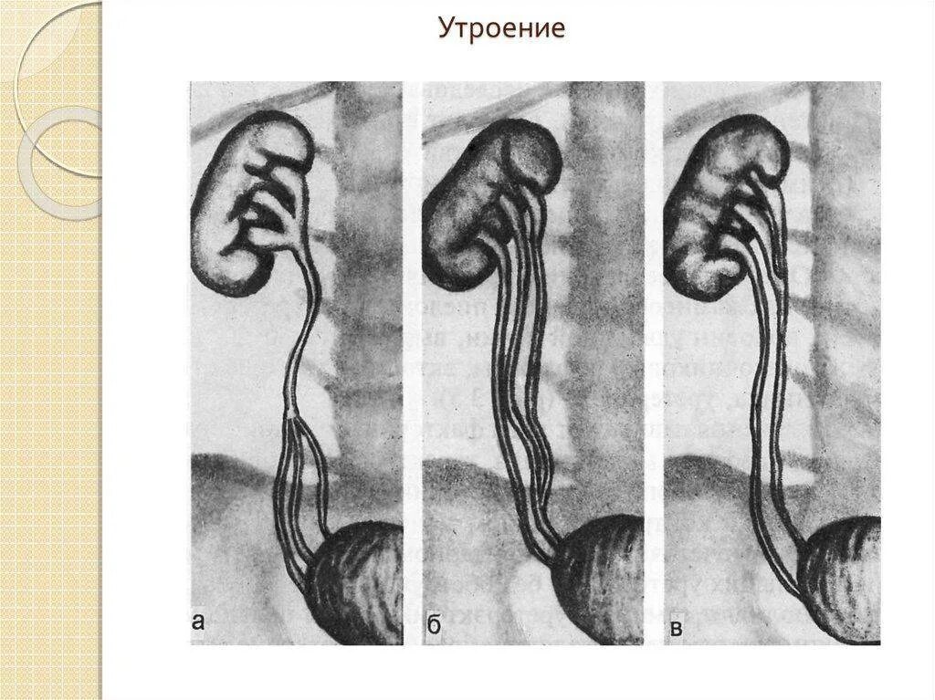 Удвоение мочеточника. Врожденная патология мочеточника. Врожденные аномалии мочеточников.