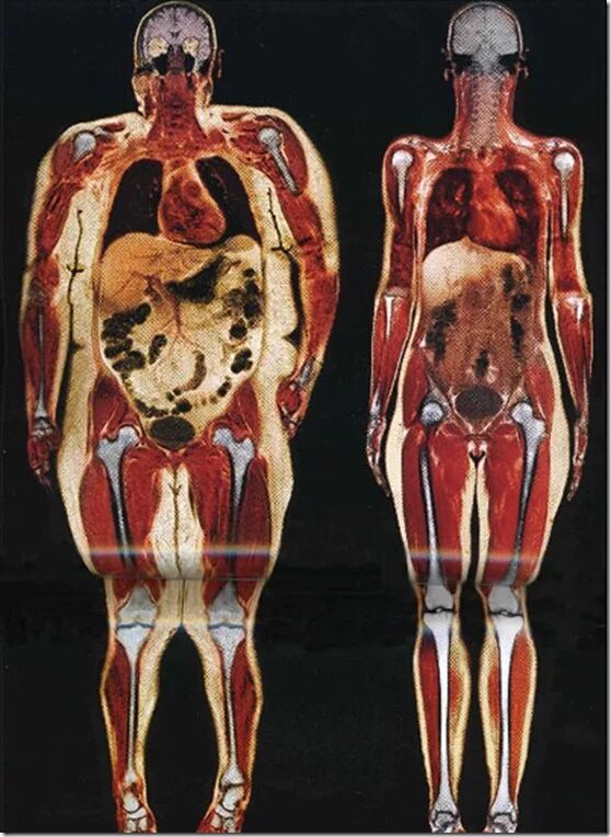 Организм на фотографии является. Висцеральный жир анатомия. Висцеральный жир рентген. Ожирение висцеральный жир. Широкая кость.