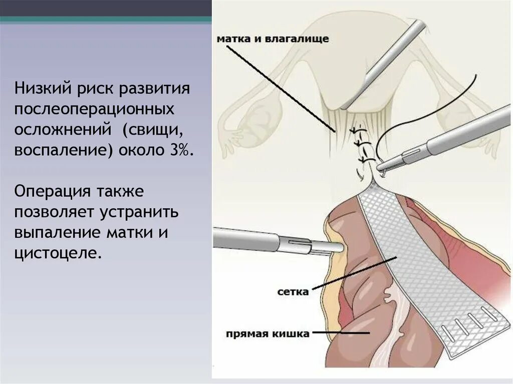 Опущение матки операция отзывы форум. Опущение матки операция отзывы форум