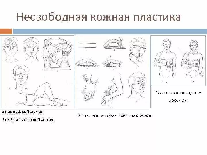 Свободная кожная пластика расщепленным кожным лоскутом. Свободная и несвободная пластика. Свободная пластинка ожи. Кожная пластика итальянский метод. Кожная пластика виды.