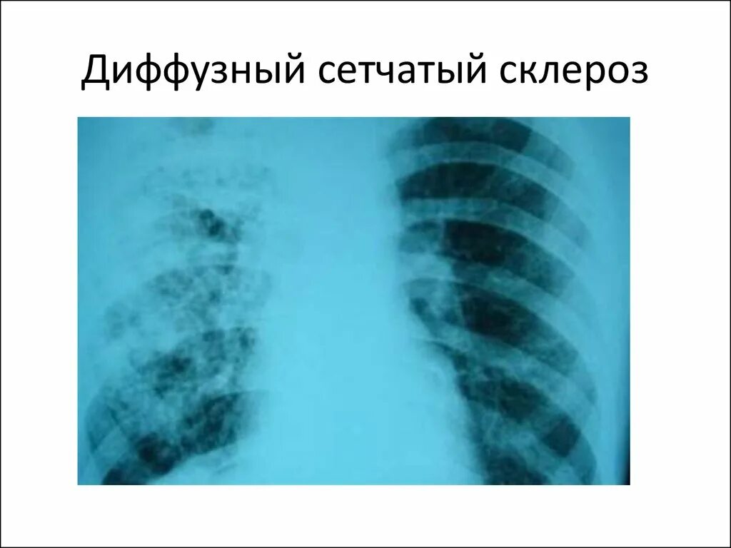 Диффузный пневмосклероз рентген. Сетчатый пневмосклероз. Диффузный сетчатый пневмосклероз. Диффузный интерстициальный склероз.