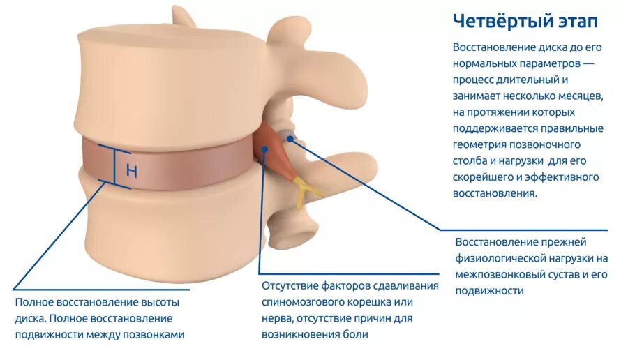 Восстановление межпозвоночных дисков. Межпозвонковые диски восстановление. Размеры межпозвоночного диска. Протез межпозвоночного диска.