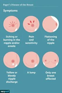 Paget's disease of the breast. 