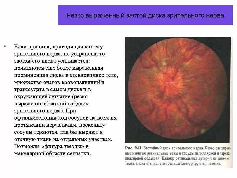 Проминенция зрительного нерва. Стушеваны границы диска зрительного нерва. Деколорация диска зрительного нерва. Периневральное пространство зрительного нерва