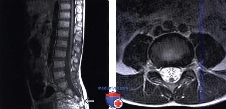 Липома терминальной нити синдром фиксированного спинного мозга. Диастематомиелия спинного мозга мрт. Фиксированный спинной мозг мрт. Фиксированный спинной мозг мрт медунивер.