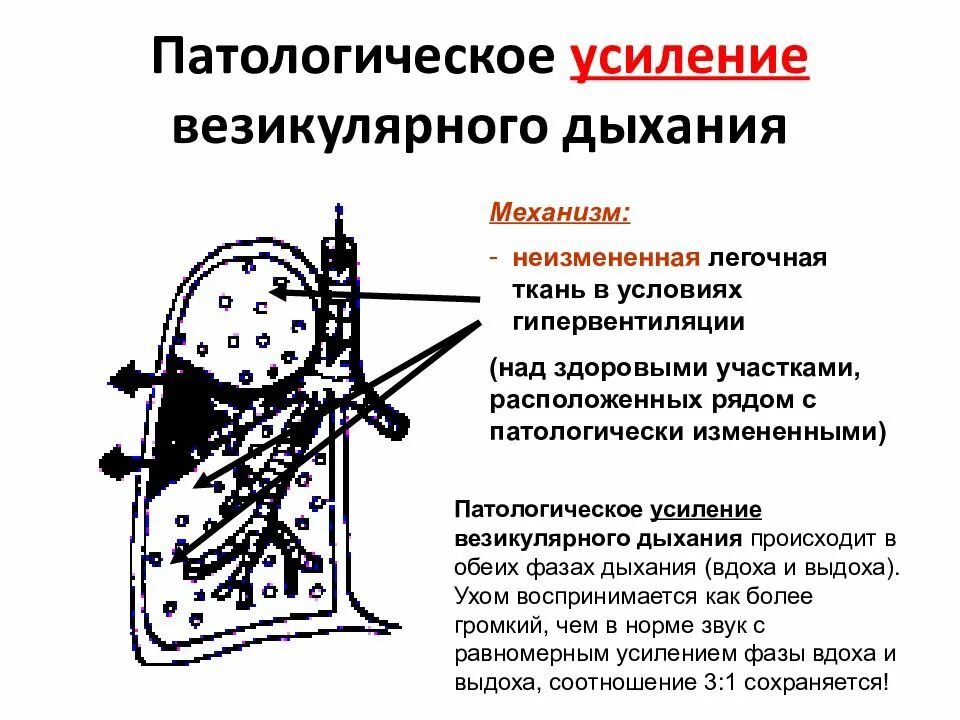 Аускультация везикулярного дыхания. Патологическое везикулярное дыхание. Патологическое усиление везикулярного дыхания. Механизм возникновения везикулярного дыхания. Причины патологического усиления везикулярного дыхания.