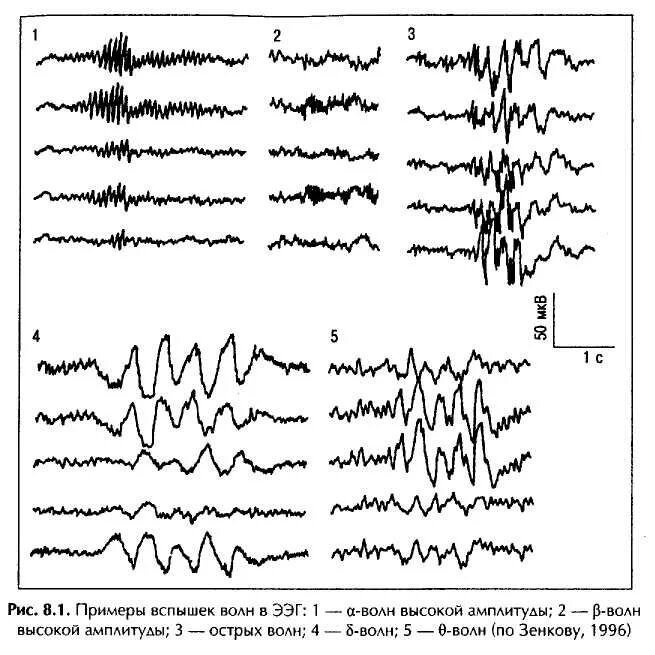 ЭЭГ волны патологические. Вспышки Дельта волн на ЭЭГ. Амплитуда ритмов ЭЭГ. ЭЭГ патологический Альфа ритм. Медленные волны на ээг
