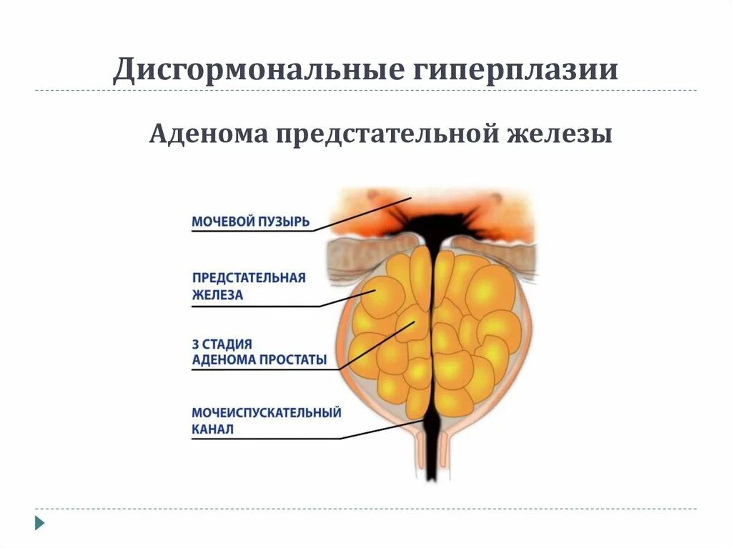 Аденома предстательной железы диагностика. Аденома предстательной железы классификация. Аденома простаты железы. Гиперплазия предстательной железы клиника. Первые признаки предстательной железы